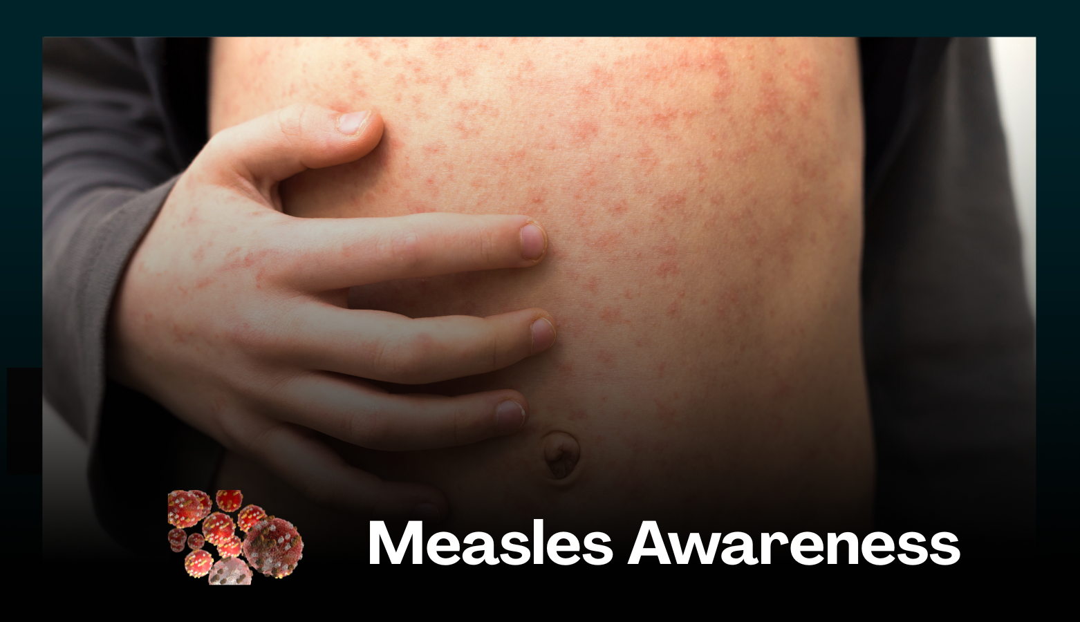 Measles